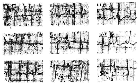 慢性肺心病的心电图改变 