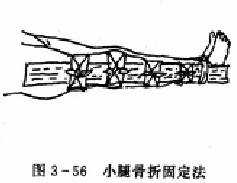  小腿骨折固定法