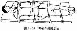 脊椎骨折固定法