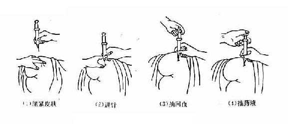 注射操作方法