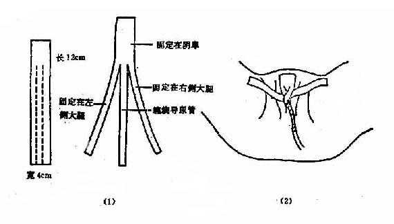 女病人留置导尿管固定法