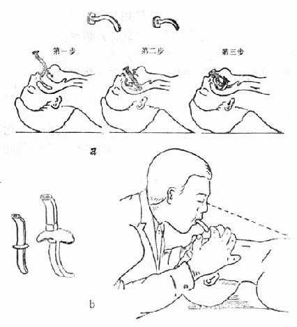 通过S形塑管进行口对口呼吸