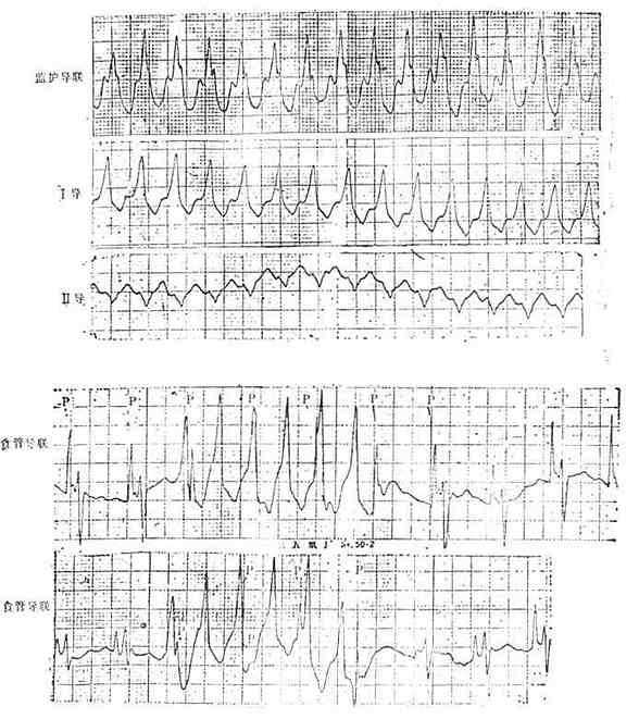 食管导联心电图室速。显示心房电活动波群(P)