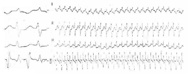 旁路折返室上速心电图