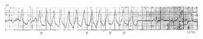 室性心动过速的心电图