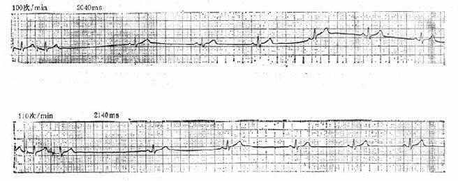 病窦的复律时间