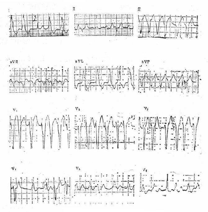 预激综合征合并心房颤动