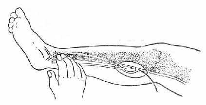 膝下内侧切口显露?s动脉及其分支