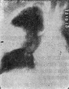 段、叶性实变之X线表现