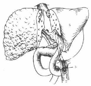 原位辅助性肝移植