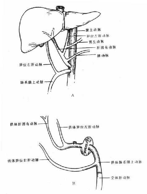 病人供肝体肝动脉变异情况