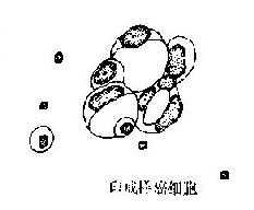 浆膜腔积液内大细胞型腺癌癌细胞示意图