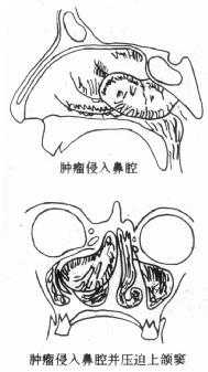 鼻咽纤维瘤