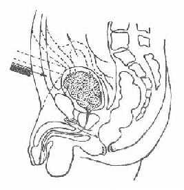 直接暴力所致膀胱破裂