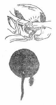 骨盆骨折所致膀胱破裂