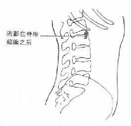 肾结石X线侧位平片
