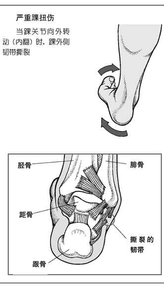 踝扭伤