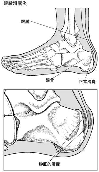 跟腱滑囊炎