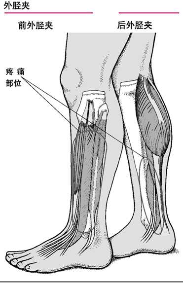 外胫夹