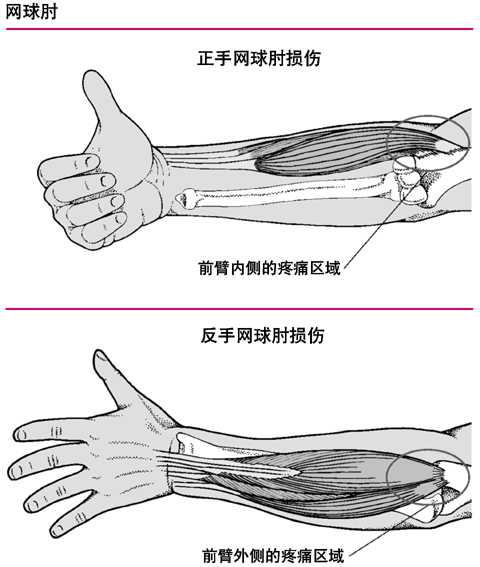反手网球肘