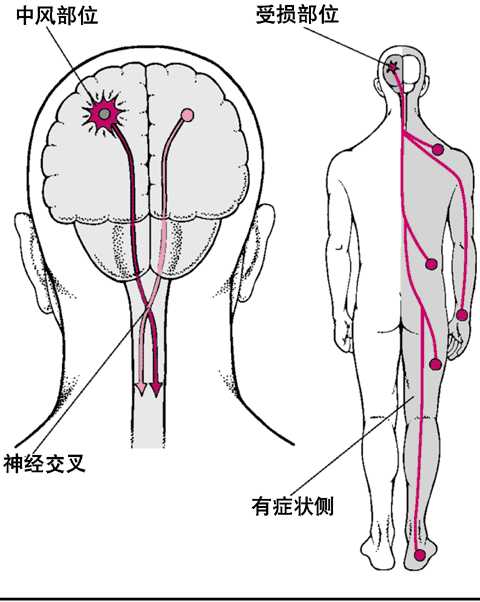 中风