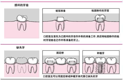 桩冠、固定桥和种植体