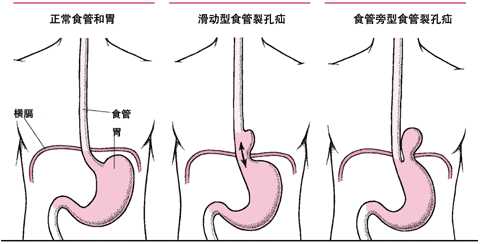 食管裂孔疝