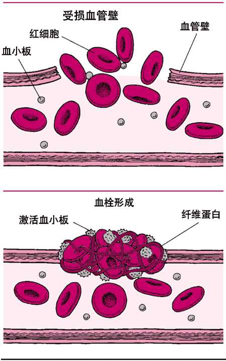 血凝块