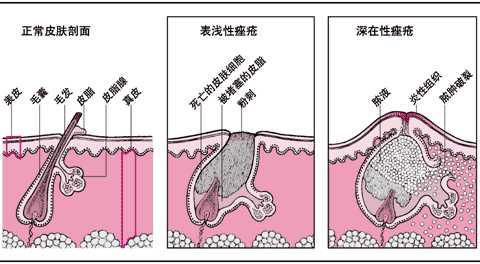 表浅性痤疮与深在性痤疮比较