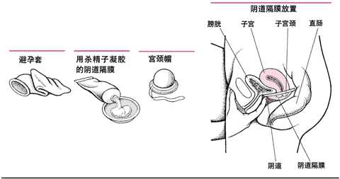 屏障避孕