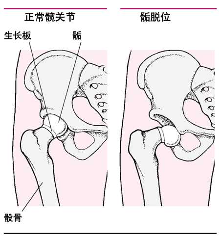股骨头骨骺滑脱