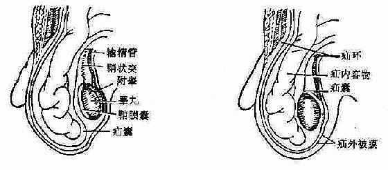 腹股沟斜疝结构特点