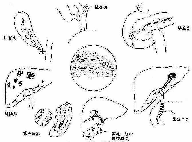 胆道蛔虫病所致并发症