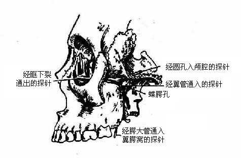 翼腭窝