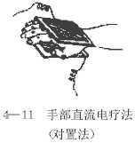 手部直流电疗法