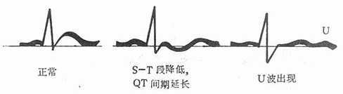 低钾血症的心电图变化
