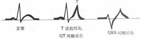 高钾血症的心电图变化