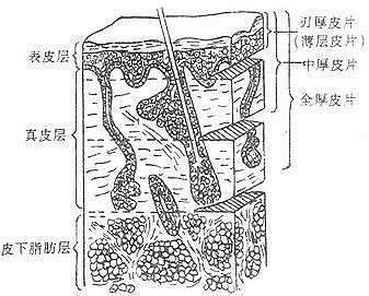 皮肤组织与皮片分类示意图