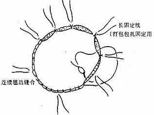 大片植皮缝合法