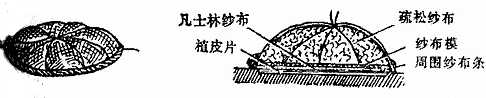 植皮后打包包扎法