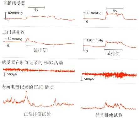 正常排便与盆底肌协调困难