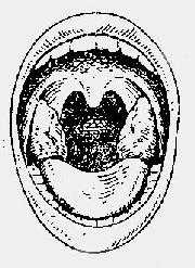 扁桃体位置及其大小分度示意图