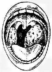 扁桃体位置及其大小分度示意图