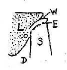 胆囊结石“WES”征