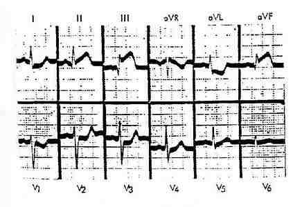 急性下壁心肌梗塞