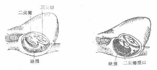 原发孔型房间隔缺损