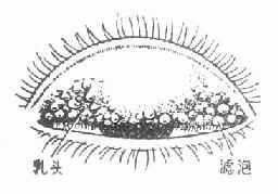 沙眼的乳头与滤泡