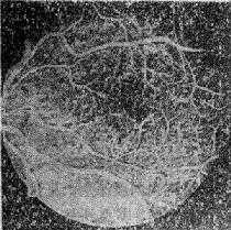 糠尿病性视网膜病变
