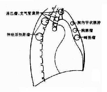 纵隔肿瘤发生部位