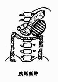 胰腺囊肿